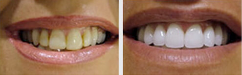 Before and After Teeth WHitening in Forest Hills