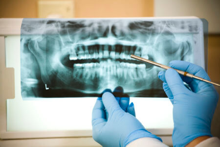 Forest Hills Dentistry gives several reasons for why you would need a root canal.
